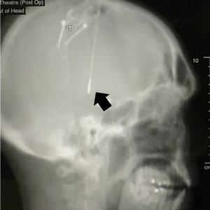 Arrow indicates the end of one wire deep within the brain.