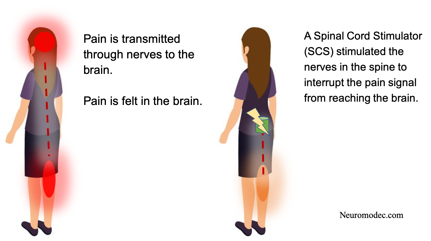What is Spinal Cord Stimulation (SCS)?