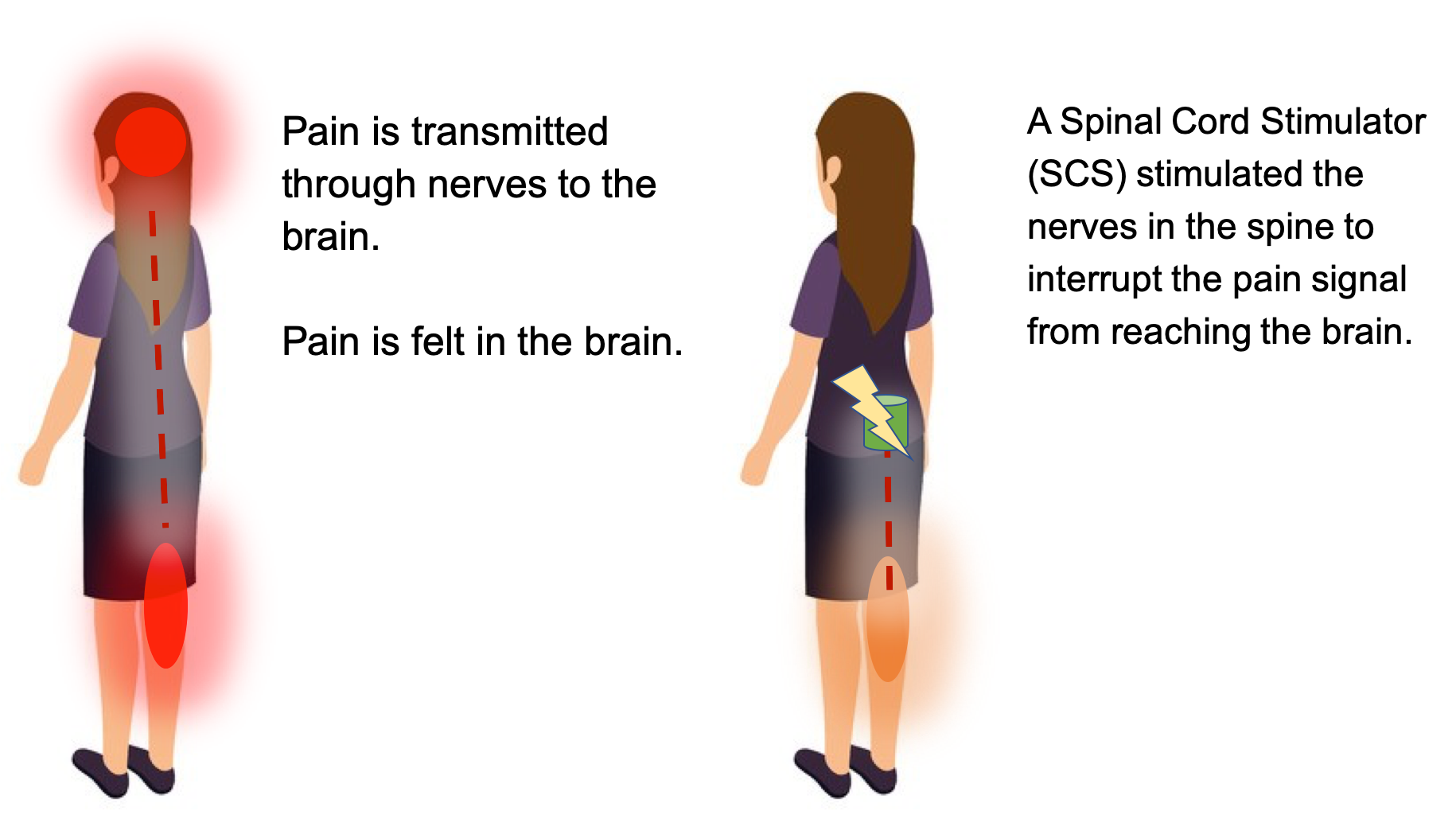 Complications of Spinal Cord Stimulator